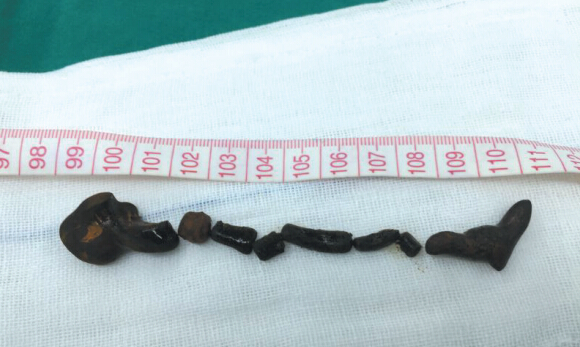 10厘米蛔虫在老妇胆管安家 蛔虫尸体被胆汁包裹成结石