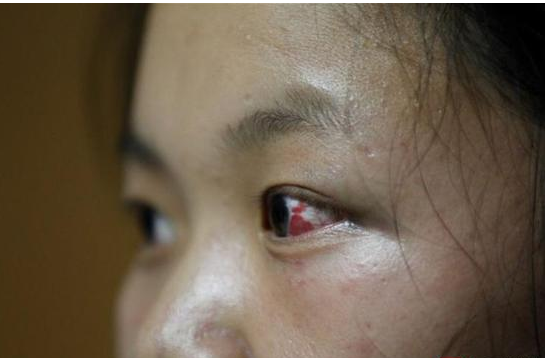 15����Ů��3��ͬѧΧŹ60���� ���������۾���Ѫ