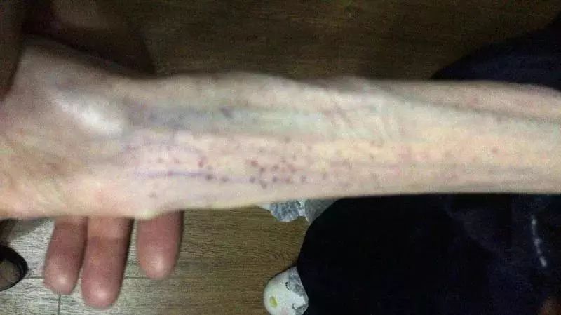 女孩减肥剩50斤（图）瘦成植物人堪比自杀！为什么这么瘦？