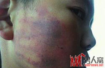事发后第三天，小明脸上被打的痕迹仍然明显。
