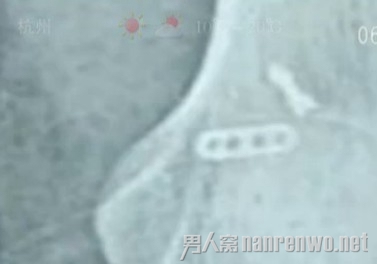 浙江一患者术后体内留钻头 取钻头需要重新打开骨头