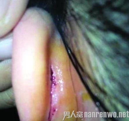 女童被幼师扯裂耳朵还威胁