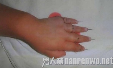 女童仿大人切菜切掉4指 女童仿大人切菜切掉4指