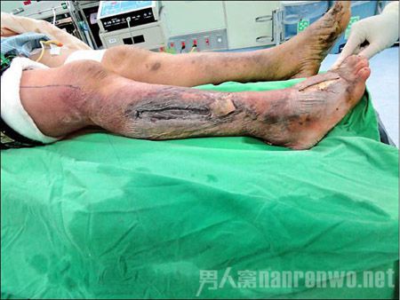 男子感染食肉菌