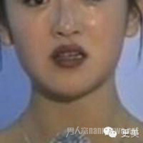 谢娜牙齿