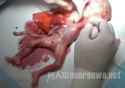 徐女士排出的死胎