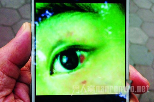 黄琪被打后拍下的照片，照片中显示其眼眶淤肿以及眼球出现血块