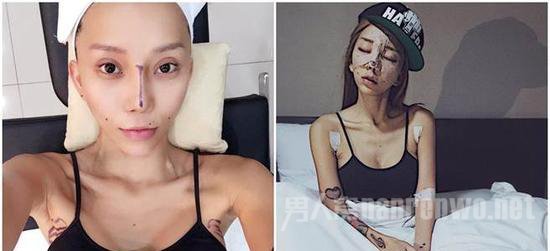 林云整容手术后