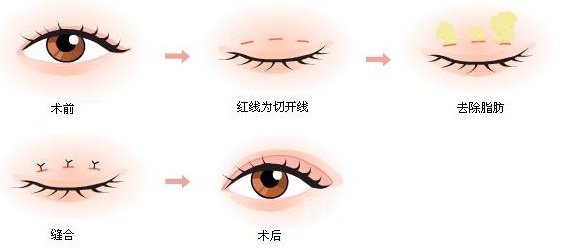 三点式