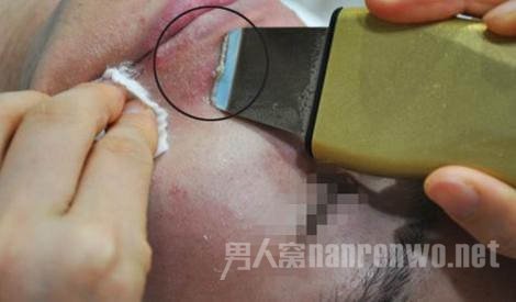 激光去痘印手术图