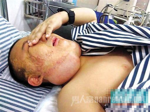父亲一时意气点燃汽油 儿子严重烧伤被骂“丑八怪”