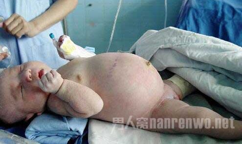孕妇产下胎中胎