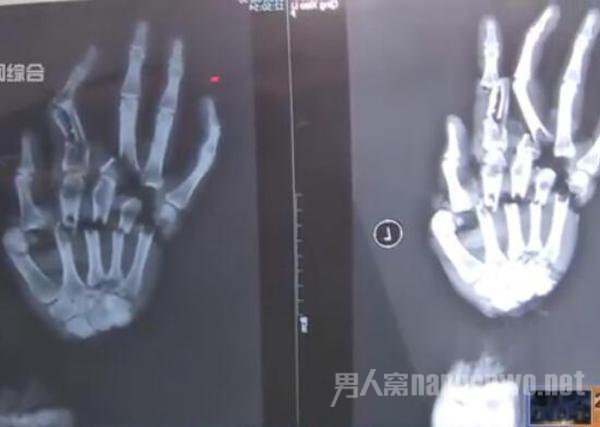 左手被砍得只剩皮连骨