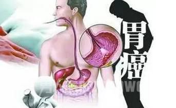 胃癌