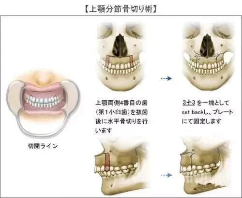 正颌手术